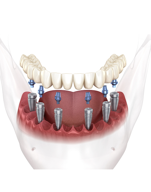 implant img